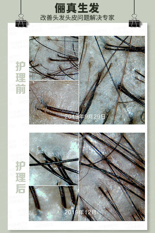 頭油、頭癢