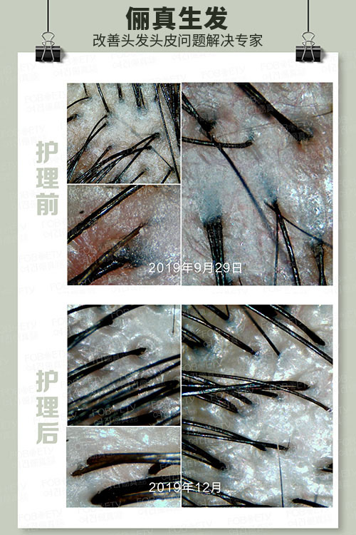 頭油、頭癢