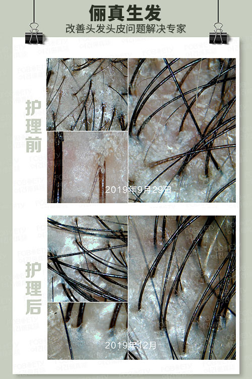 頭油、頭癢